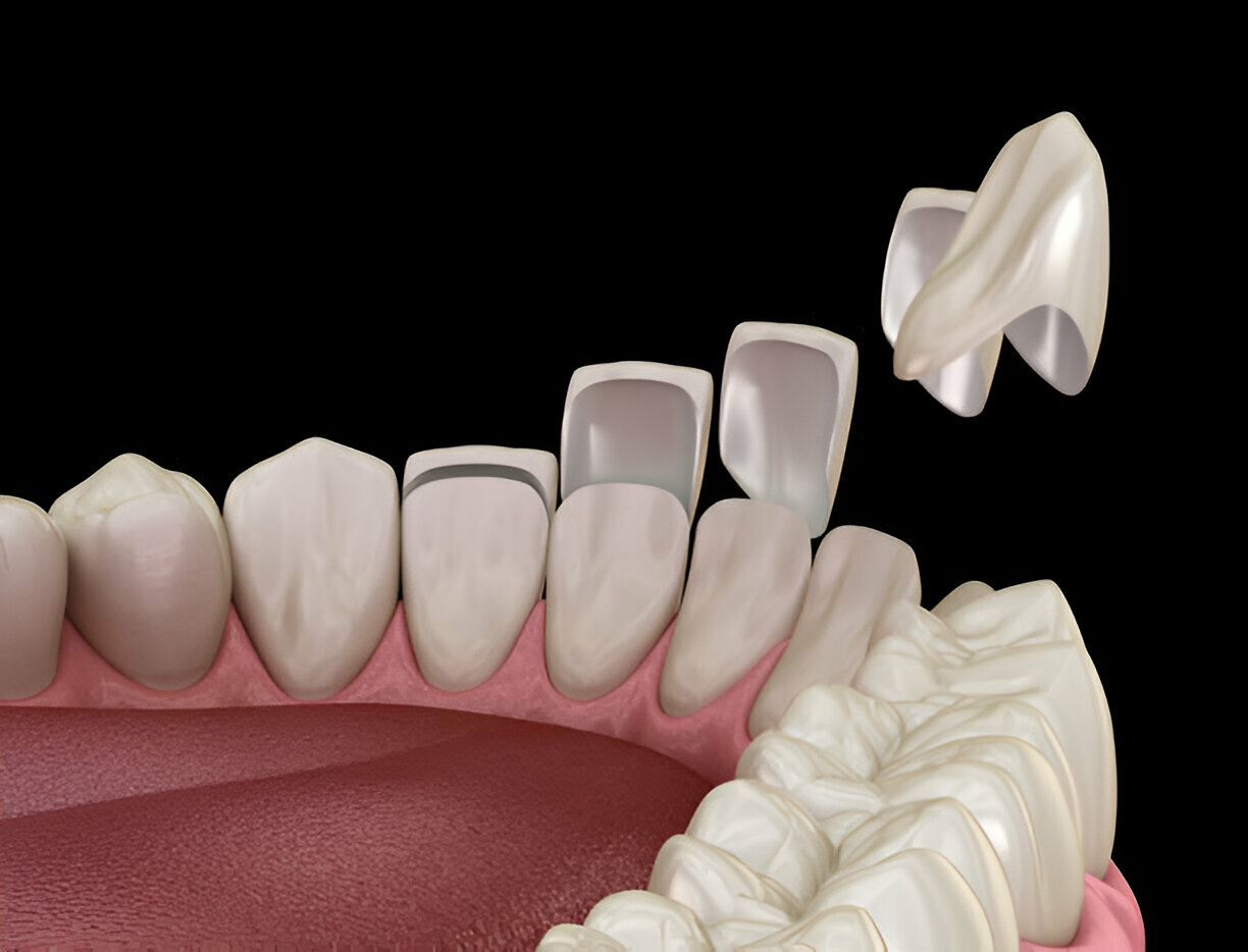 How Porcelain Veneers Can Fix Your Dental Imperfections_2