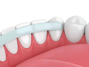 A Step-by-Step Guide to the Dental Bonding Process_FI