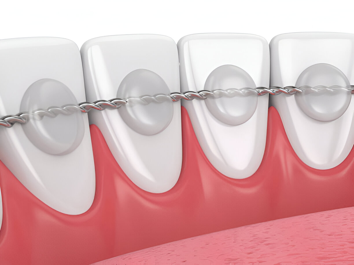 A Step-by-Step Guide to the Dental Bonding Process_1