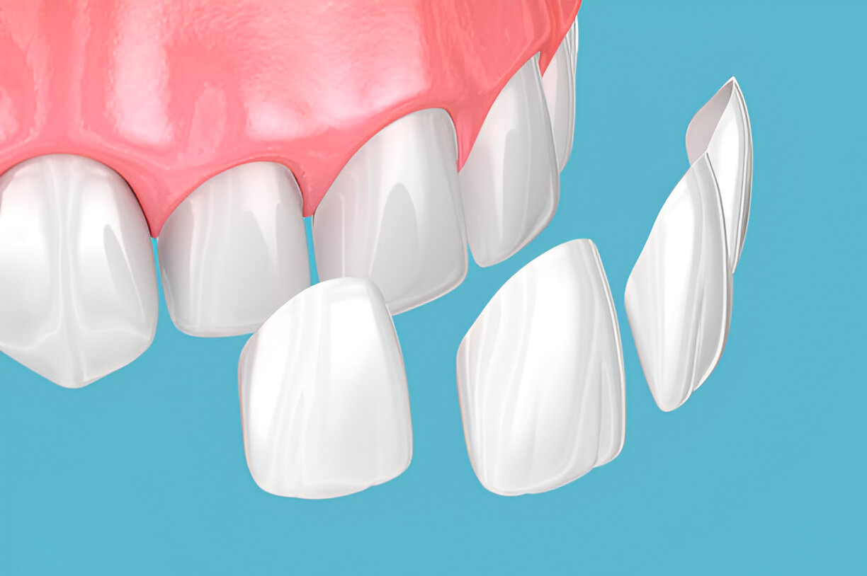 A Step-by-Step Guide to the Dental Bonding Process_3