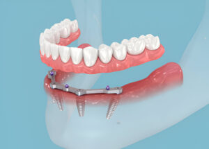 Why Choose Gentle Dentistry of Las Colinas for Dentures in Irving, TX?_FI