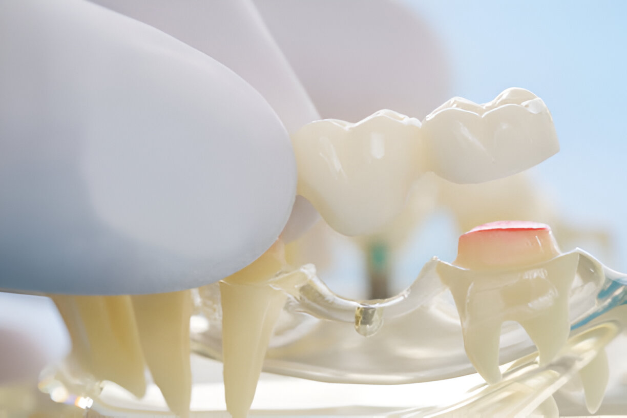 How Gentle Dentistry of Las Colinas Specializes in Replacing Dental Bridges in Irving, Texas_1