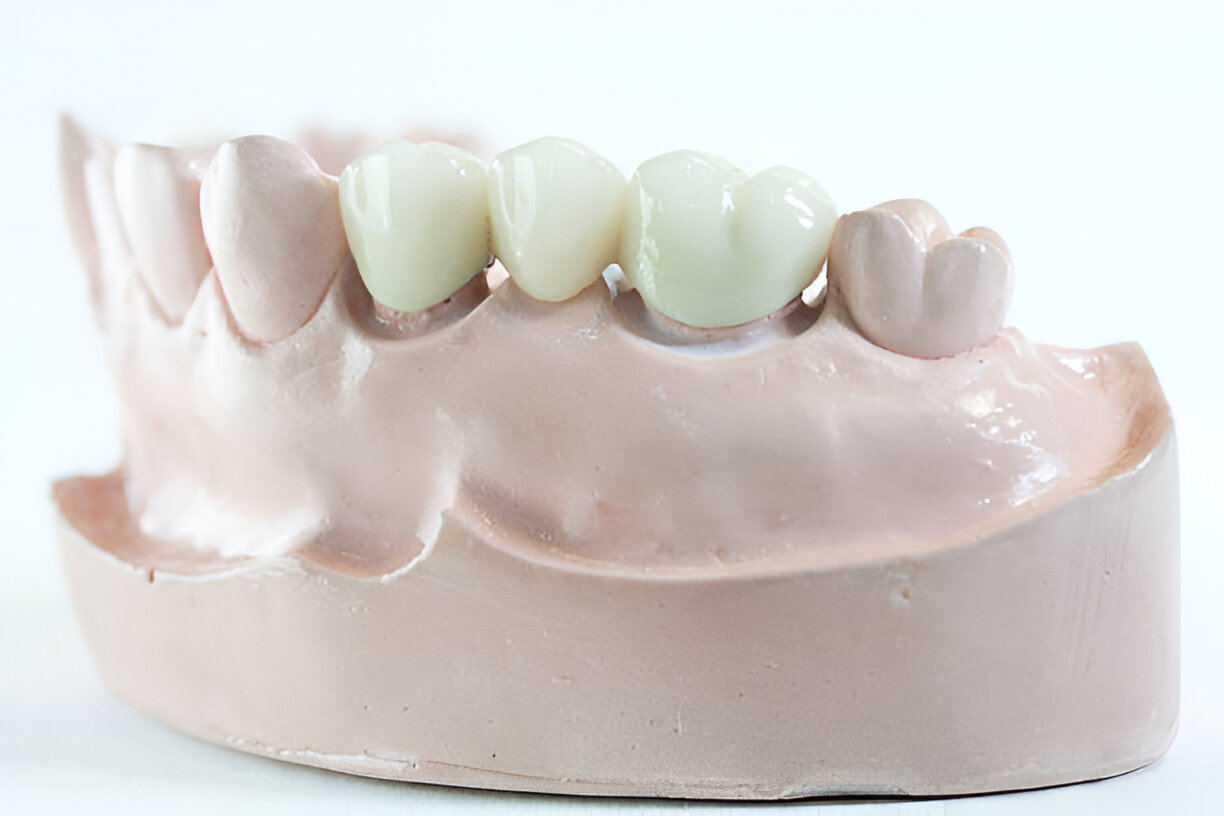 How Gentle Dentistry of Las Colinas Specializes in Replacing Dental Bridges in Irving, Texas_3