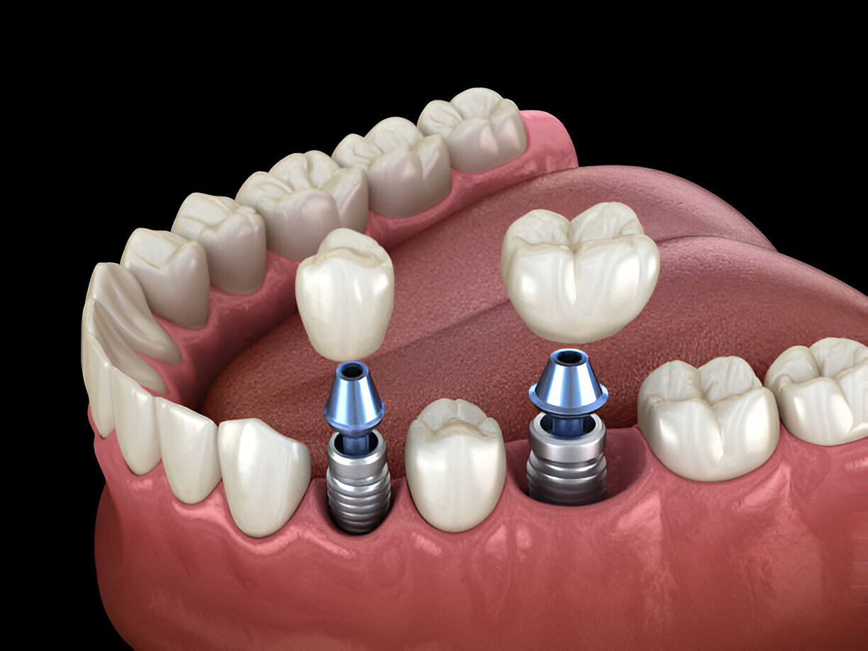 Why Choose Gentle Dentistry of Las Colinas for Dental Implants in Irving, Texas_FI